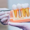 dental-implant-marketing